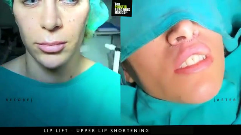 Lip Lift in Mexico - TopPlasticSurgeonsMexico 9